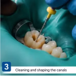 root_canal_step_3