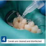 root_canal_step_4 (1)