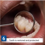 root_canal_step_6