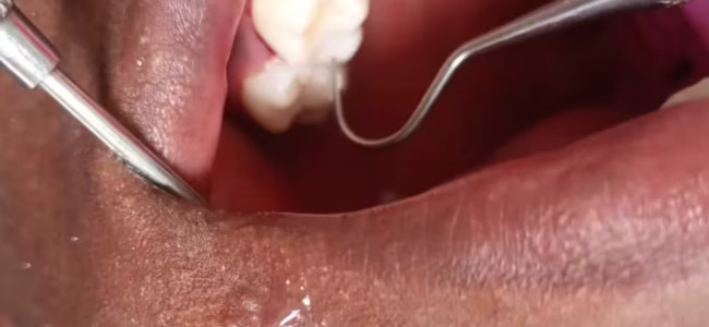Filling_After