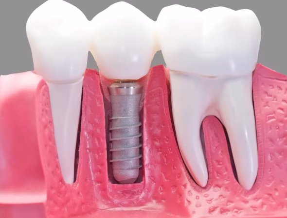 Implant 1