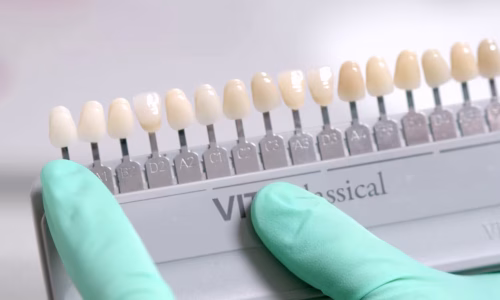 dental veneers 2